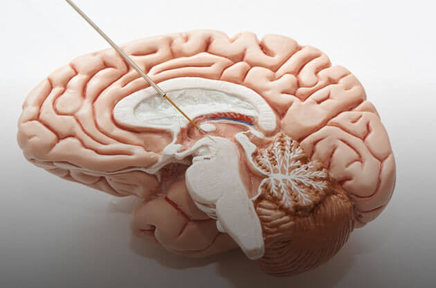 Brain Injury