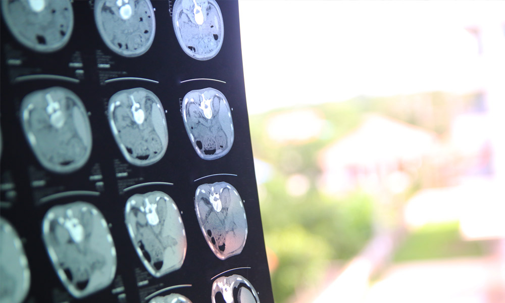 tbi, neurodegeneration, traumatic brain injury