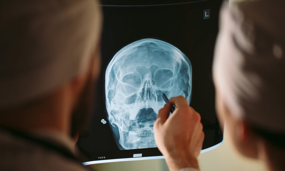motorcycle accident, traumatic brain injury, brain injury, head injury