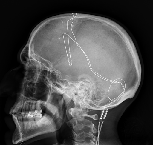 Deep Brain Stimulation Device